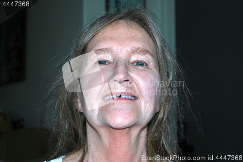 Image of Female with missing tooth cap.