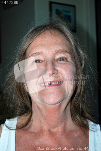 Image of Female with missing tooth cap.