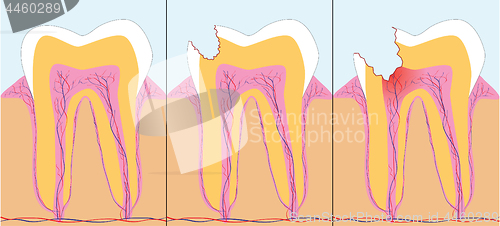 Image of Three phase of caries