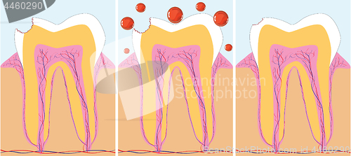Image of Three phase of caries treatment