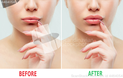 Image of Before and after lips filler injections. Beauty plastic. Beautiful perfect lips with natural makeup.