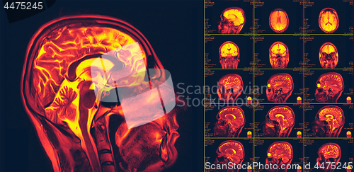 Image of Magnetic resonance imaging of the brain. MRI scan
