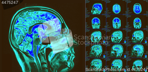 Image of Magnetic resonance imaging of the brain. MRI scan