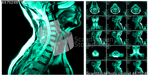 Image of Magnetic resonance imaging of the cervical spine.