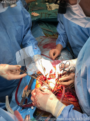 Image of Surgeons team performing organ transplantation medical surgery.