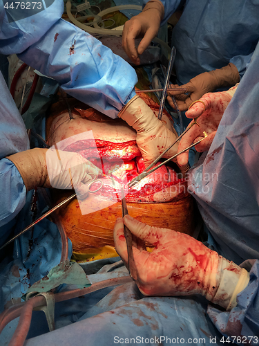 Image of Surgeons team performing organ transplantation medical surgery.