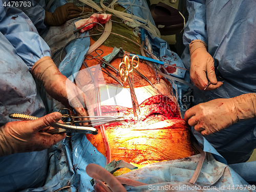 Image of Surgeons team performing organ transplantation medical surgery.