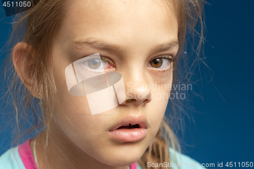 Image of Conjunctivitis in front of a ten year old girl