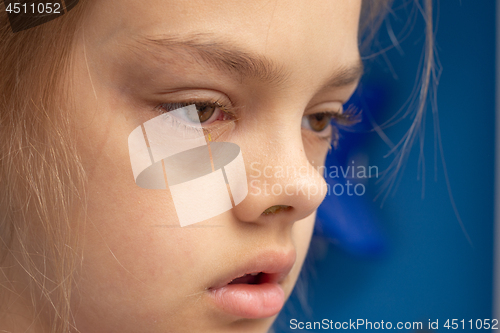 Image of Ill child, conjunctivitis on the eyes