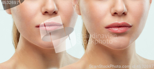 Image of Before and after lips filler injections. Beauty plastic. Beautif