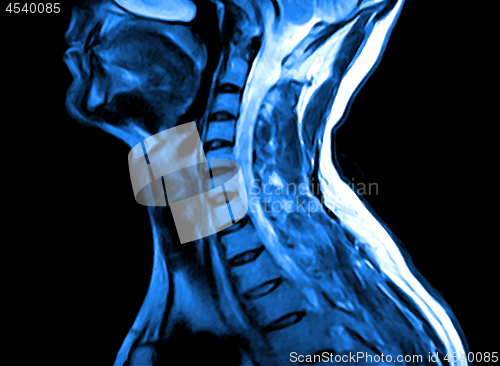 Image of Magnetic resonance imaging of the cervical spine.