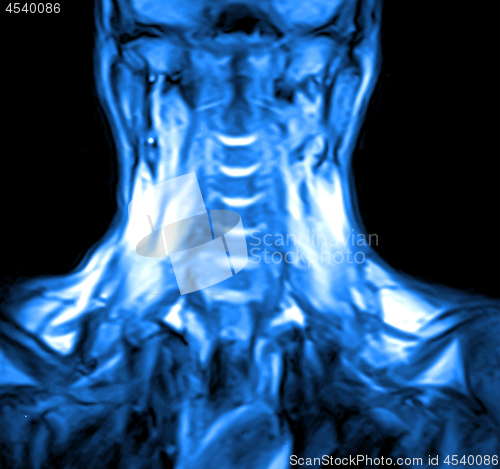 Image of Magnetic resonance imaging of the cervical spine.