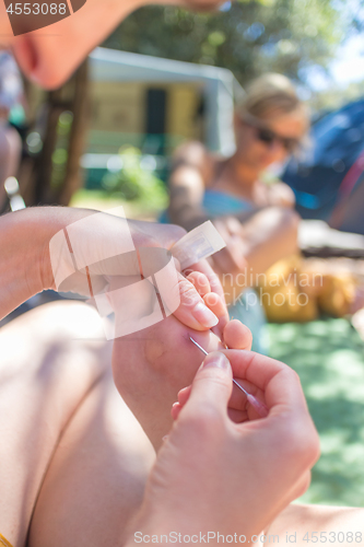 Image of Woman taking sea urchin spine out of her friends sole using medical needle.