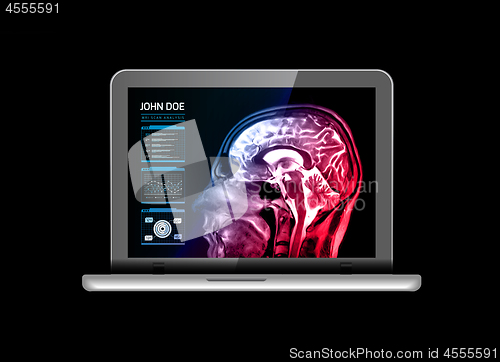 Image of Notebook monitor with medical MRI and other real-time analyzes. Medicine of the future. Vector illustration on black