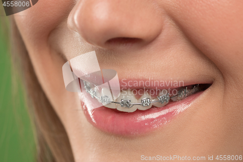 Image of Beautiful young woman with teeth braces