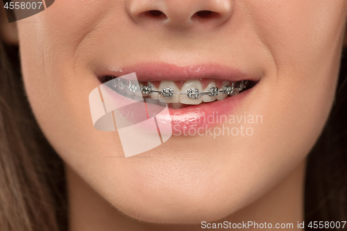 Image of Beautiful young woman with teeth braces