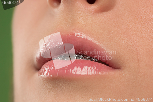 Image of Beautiful young woman with teeth braces