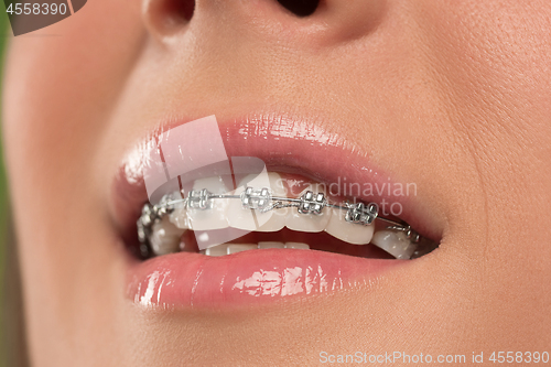 Image of Beautiful young woman with teeth braces