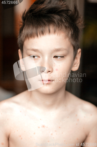 Image of Boy with chickenpox