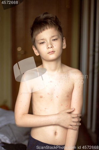 Image of Boy with chickenpox