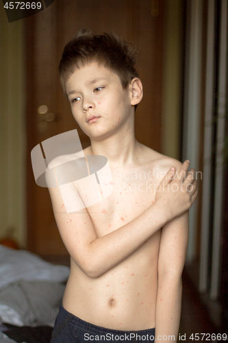 Image of Boy with chickenpox