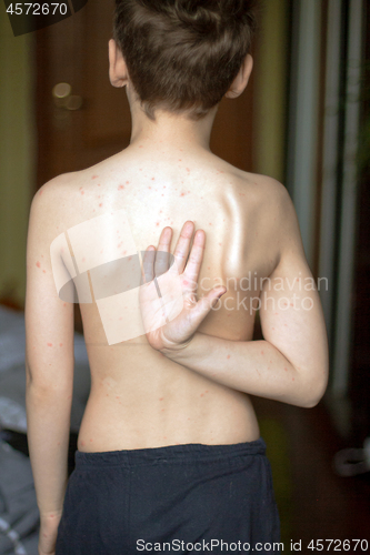 Image of Boy with chickenpox