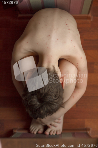 Image of Boy with chickenpox