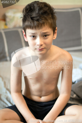 Image of Boy with chickenpox