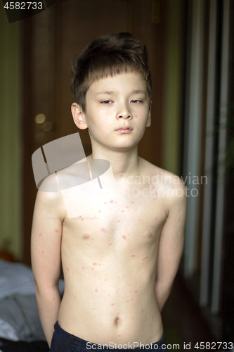 Image of Boy with chickenpox