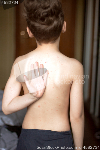 Image of Boy with chickenpox