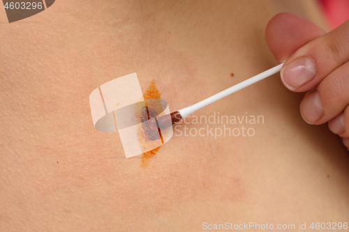 Image of Antiseptic and disinfectant drug based on iodine is applied to the wound with a cotton wand