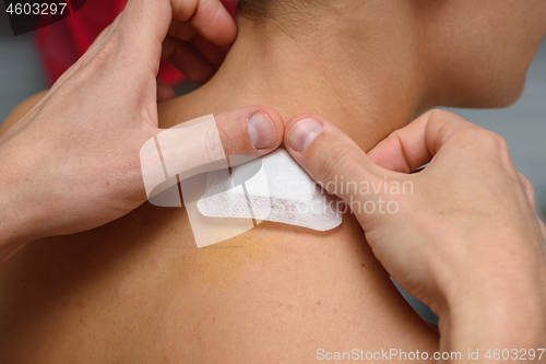 Image of A medical patch is pasted on the wound