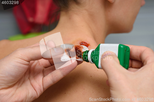 Image of Antiseptic drug is applied on bandage to treat wounds on the girl\'s neck