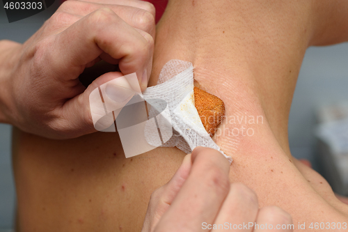 Image of Replacing a medical bandage on a postoperative wound on the girl\'s neck