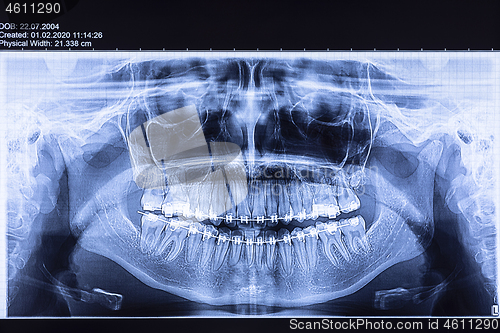 Image of Dental radiography with braces