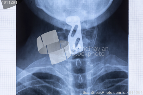 Image of Radiography of titanium plate to support the cervical spine