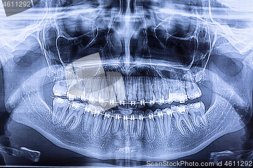 Image of Dental radiography with braces