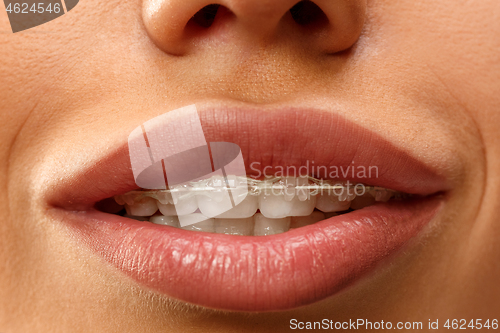 Image of Beautiful young woman with teeth braces