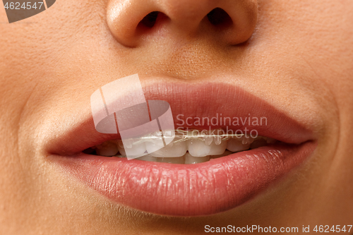 Image of Beautiful young woman with teeth braces