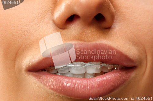 Image of Beautiful young woman with teeth braces