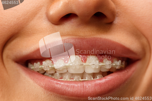 Image of Beautiful young woman with teeth braces