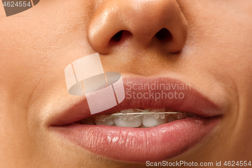 Image of Beautiful young woman with teeth braces