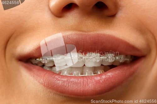 Image of Beautiful young woman with teeth braces