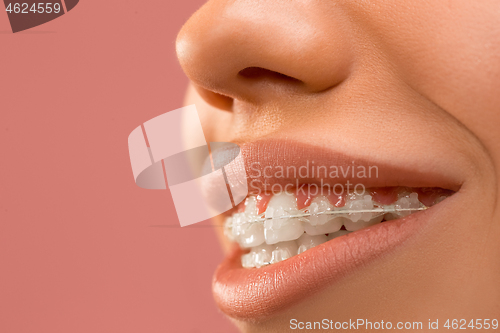 Image of Beautiful young woman with teeth braces