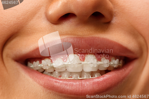 Image of Beautiful young woman with teeth braces