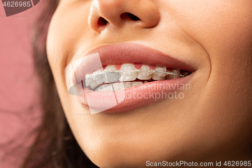 Image of Beautiful young woman with teeth braces