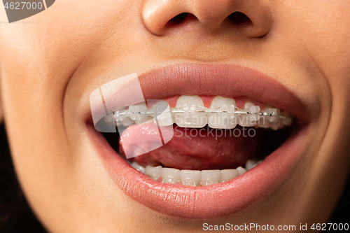 Image of Beautiful young woman with teeth braces