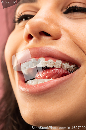 Image of Beautiful young woman with teeth braces