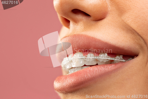 Image of Beautiful young woman with teeth braces