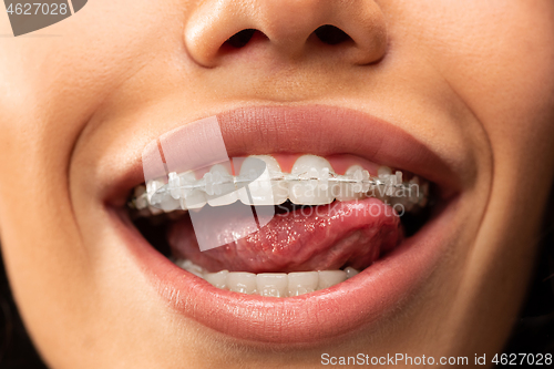 Image of Beautiful young woman with teeth braces